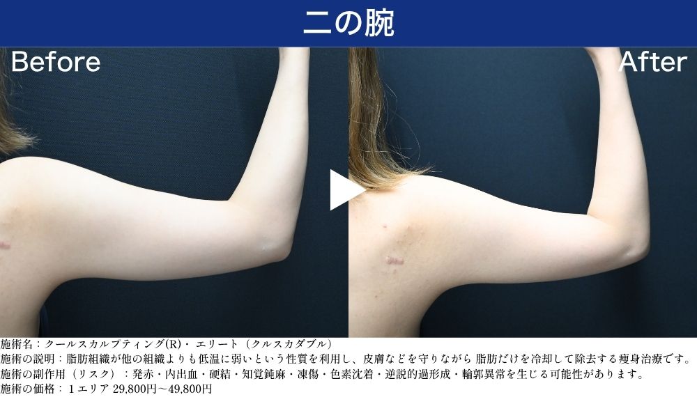 二の腕