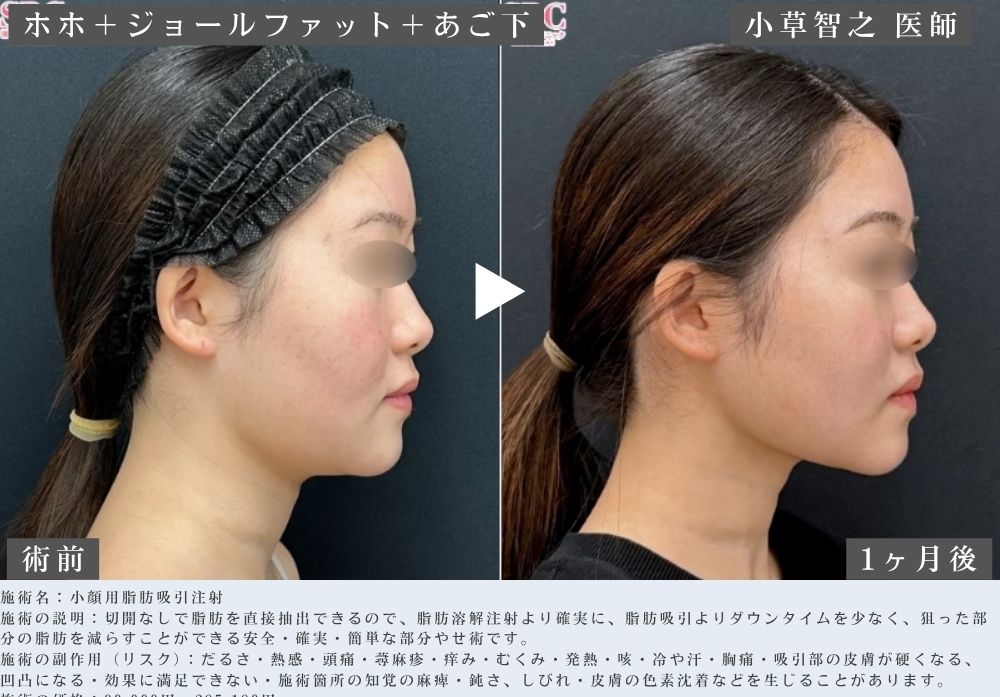 脂肪吸引注射の症例