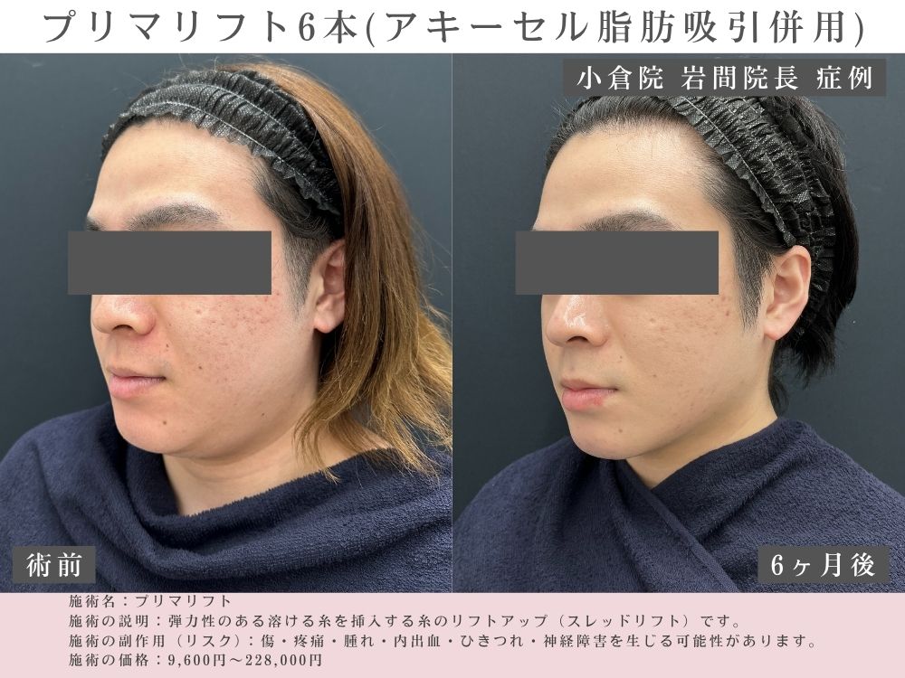 糸リフトの症例