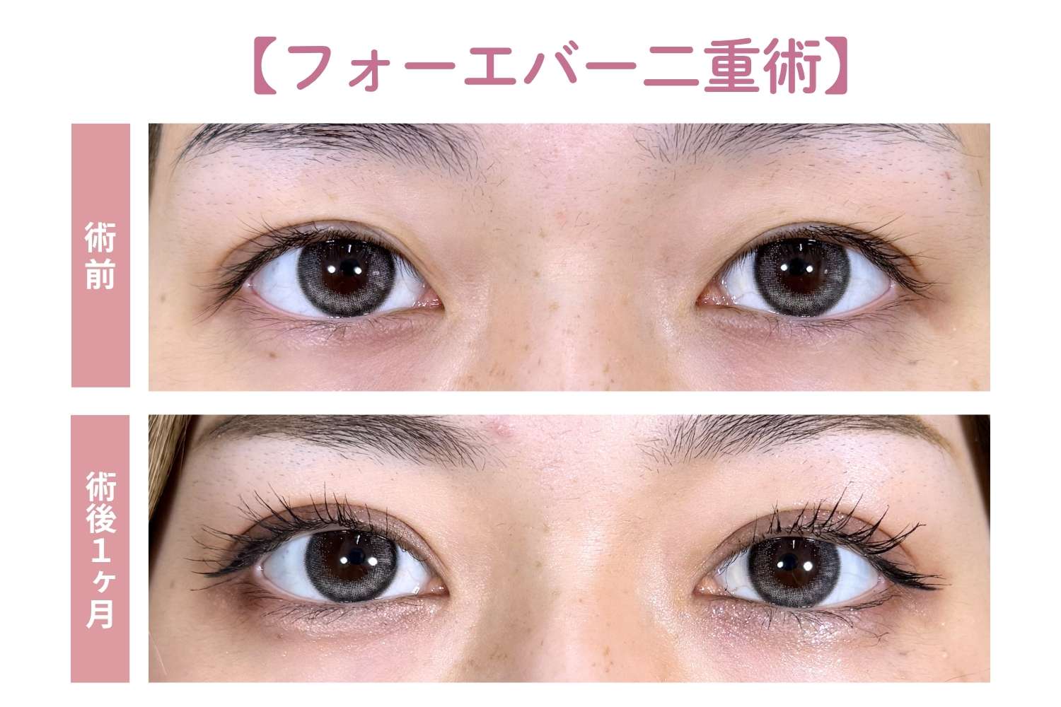 フォーエバー二重術だから叶う「Mix〜平行二重」