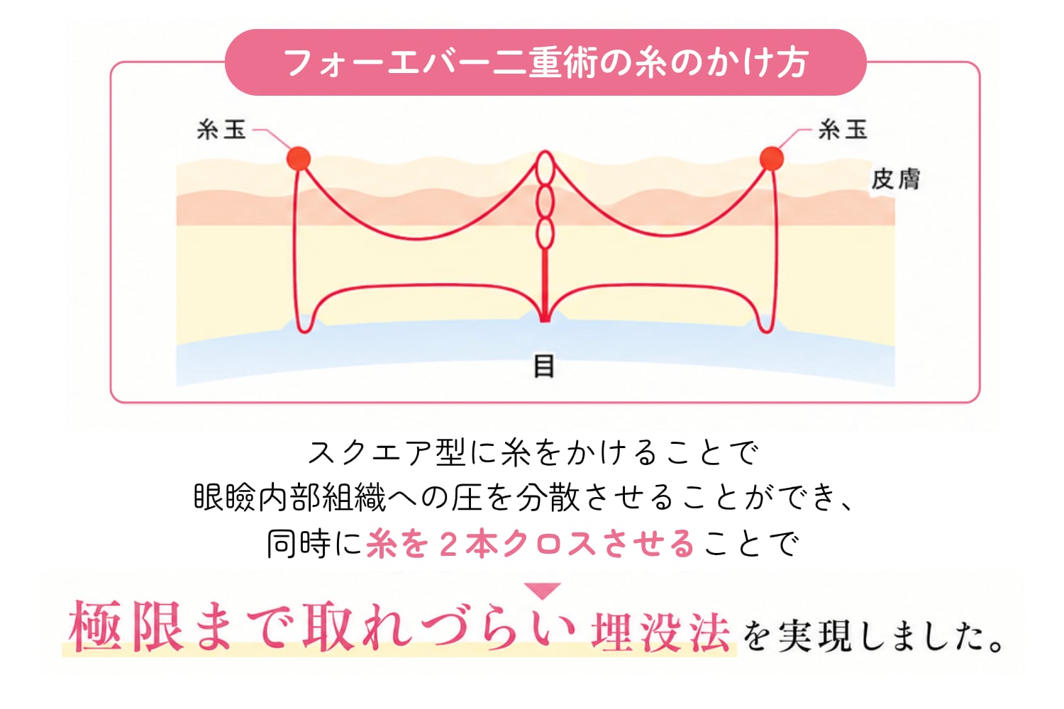 “自然さ”も“取れにくさ”も叶える人気の埋没法