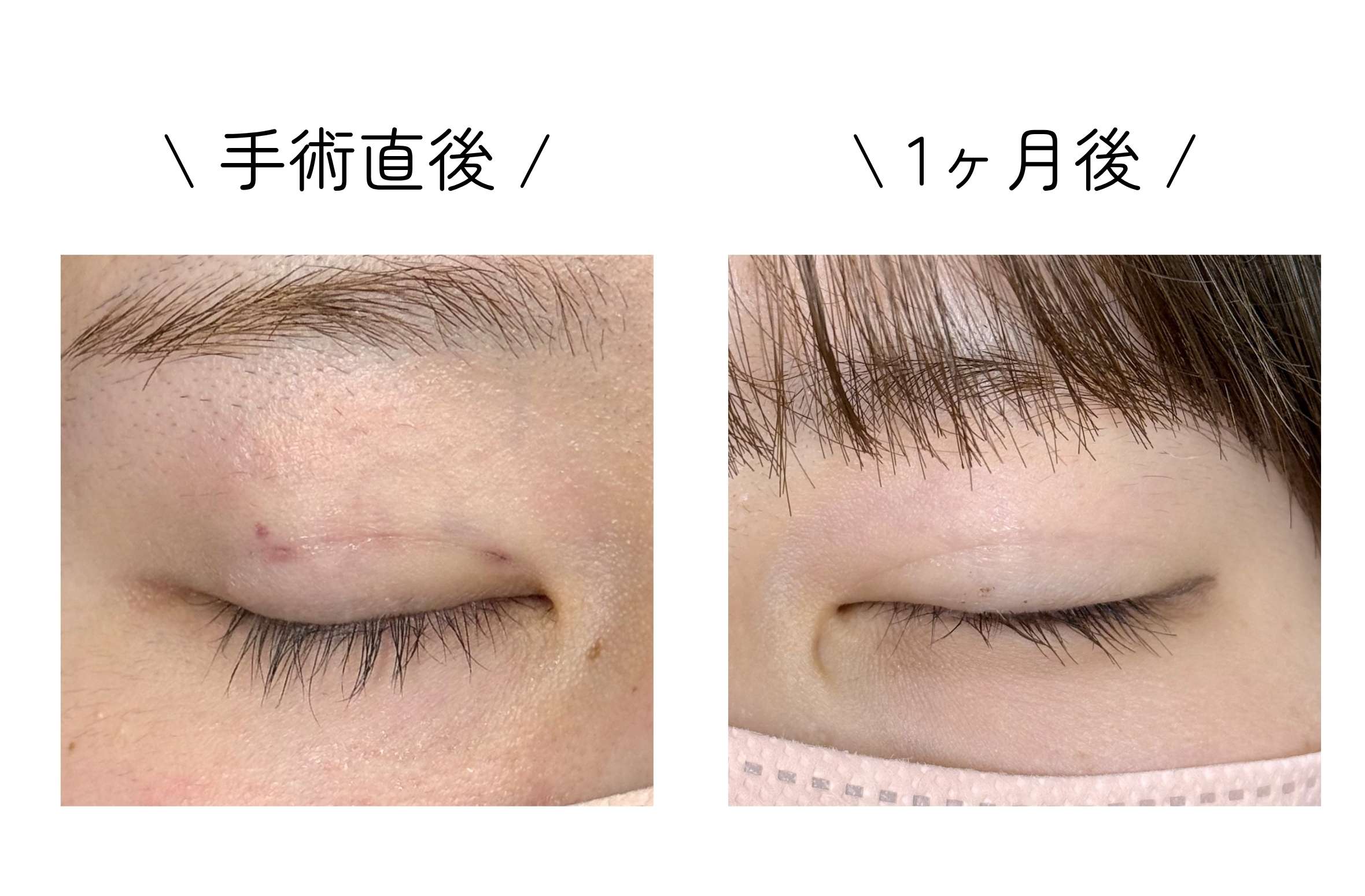 傷跡って実際どうなの？
