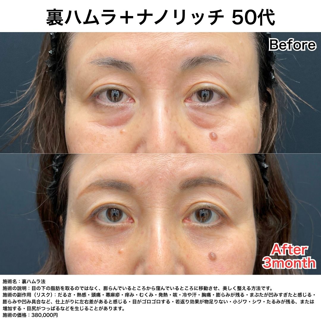 【50代女性】裏ハムラ＋ナノリッチ