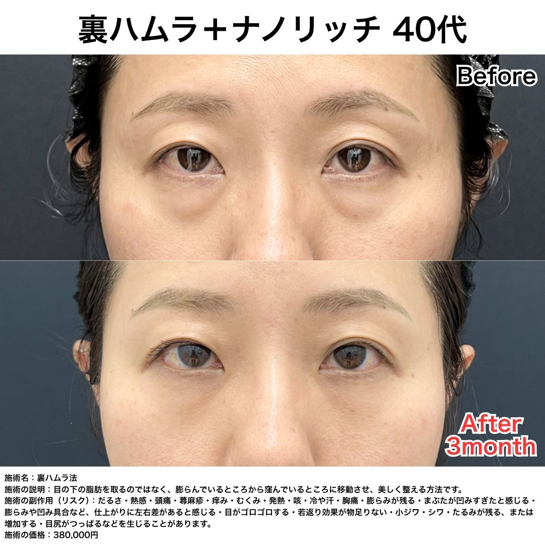 【40代女性】裏ハムラ＋ナノリッチ
