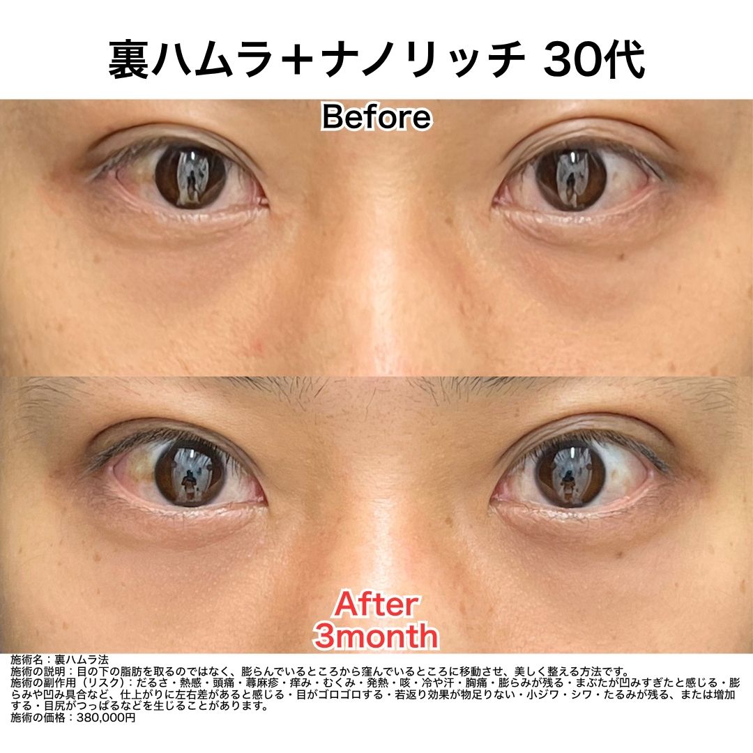 〜疲れた印象を改善し、明るい目元を〜