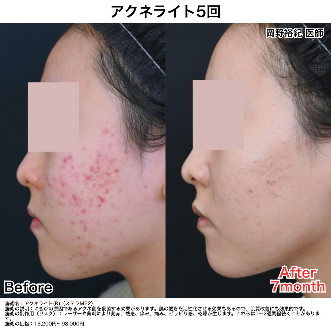 〜ニキビの原因を徹底アプローチ〜
