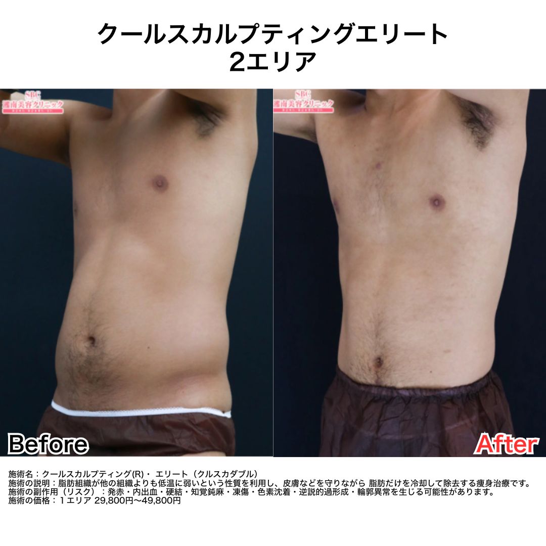①クールスカルプティングエリート