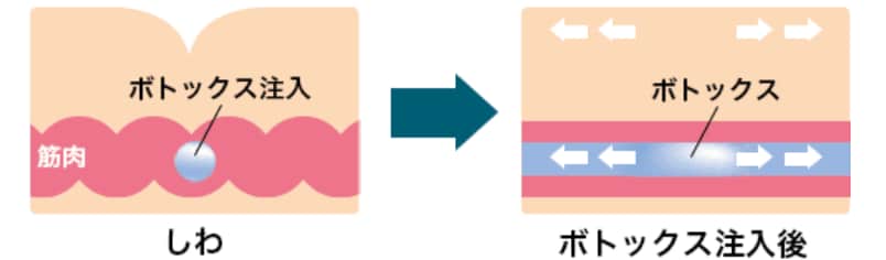 そもそもボトックスって？