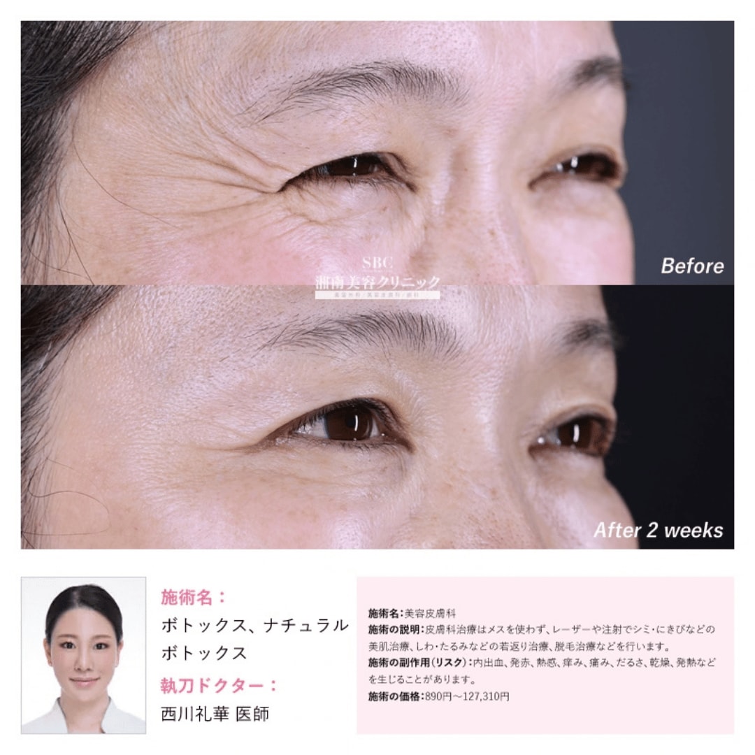 人気部位2: 目尻ボトックス<br />
<br />
