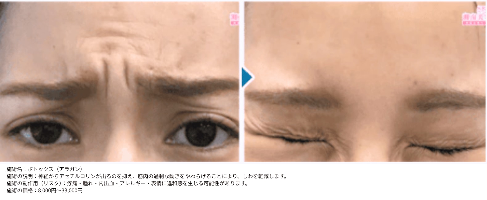 人気部位1: 眉間ボトックス