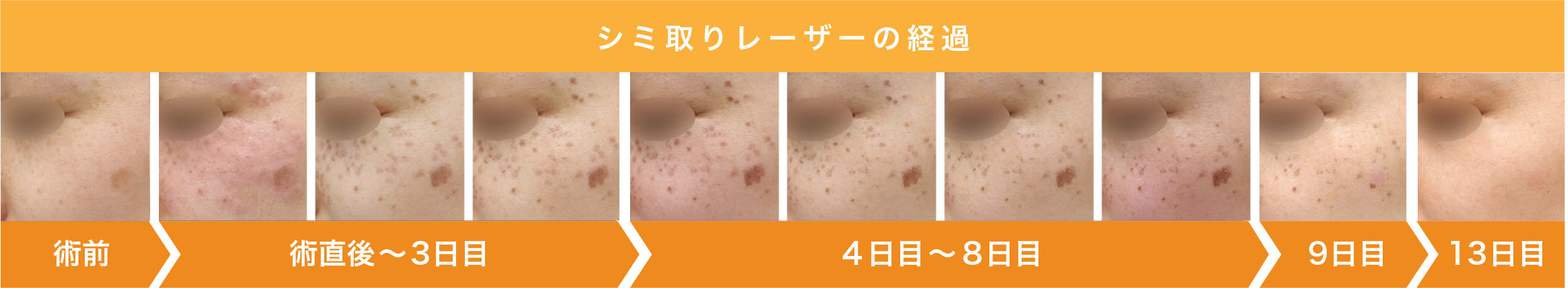 湘南美容クリニック郡山院のシミ治療【シミ取り】【そばかす】【肝斑】 - 郡山院