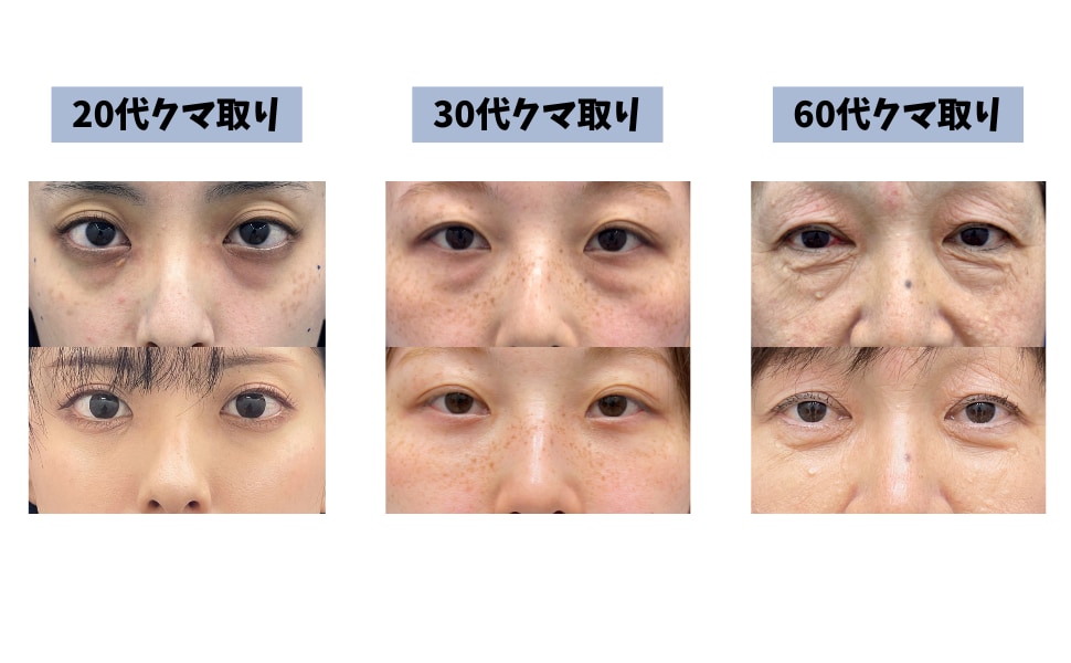 クマ取り】で一気に垢抜け！郡山でクマ取りなら、➖10歳を叶える Dr.平 