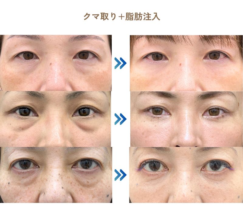 脂肪注入でお顔が明るく若返り♪