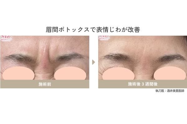 シワ改善ボトックス