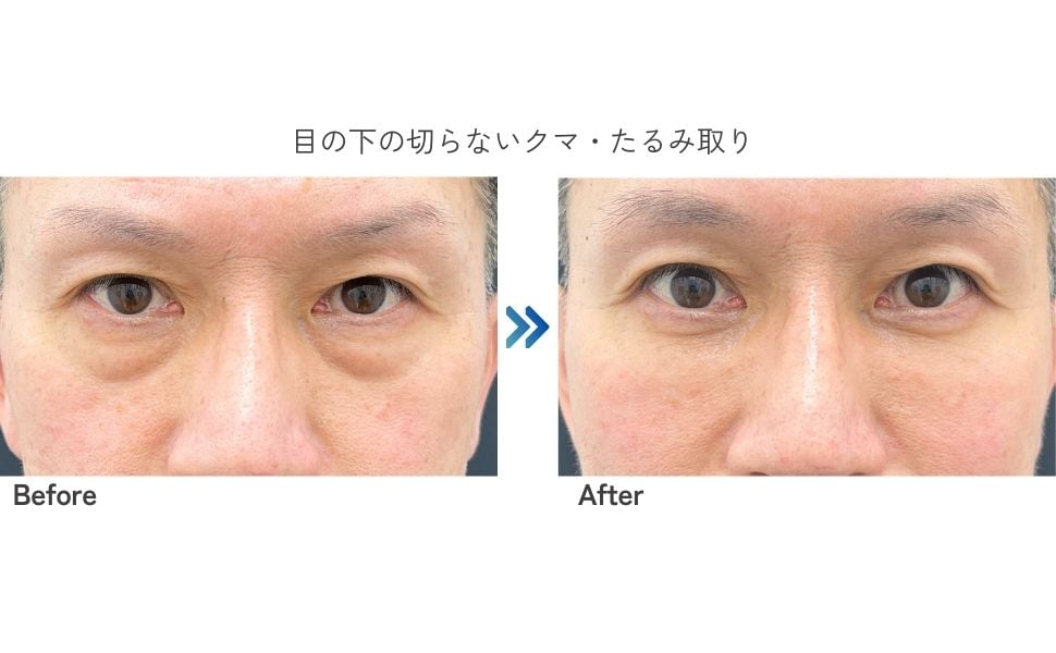目の下の切らないクマ・たるみ取り