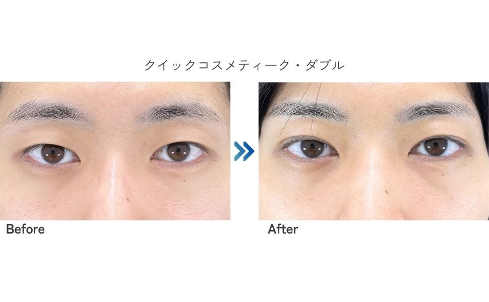 理想を叶える二重術