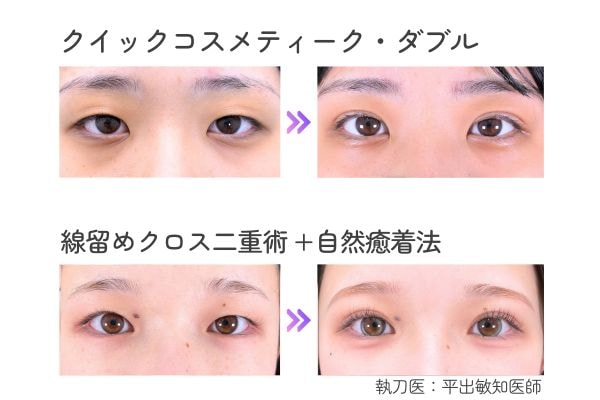 大人気の二重術メニューが特別価格に👀