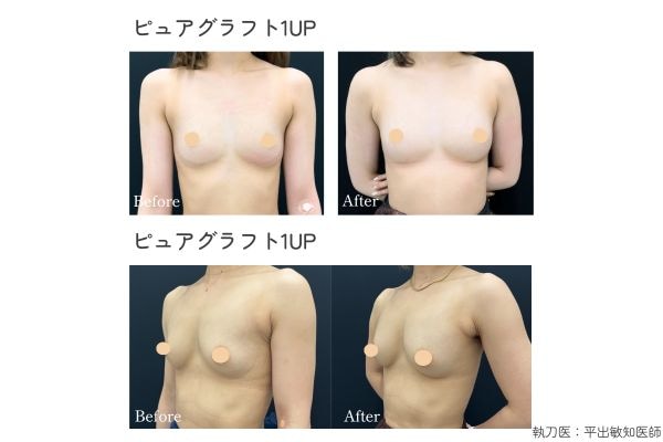 翌日からお仕事ができる豊胸術💖