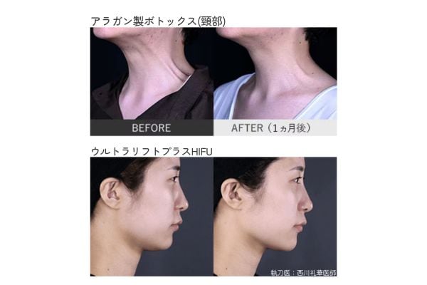 たるみやシワを改善・予防して、若返りの第1歩
