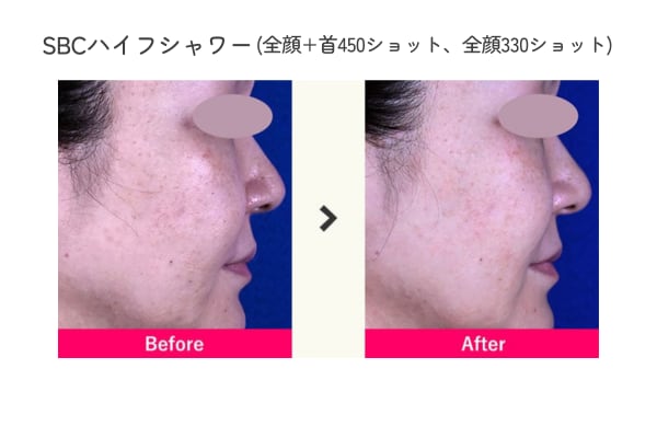 HIFUを顔全体の皮膚浅層へ照射することで、顔全体の引き締め・毛穴改善・肌質を整えます<br />
