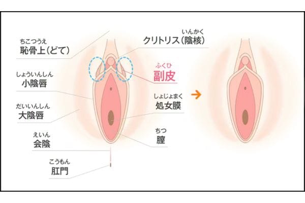 副皮除去術(抜糸あり・抜糸なし)<br />
