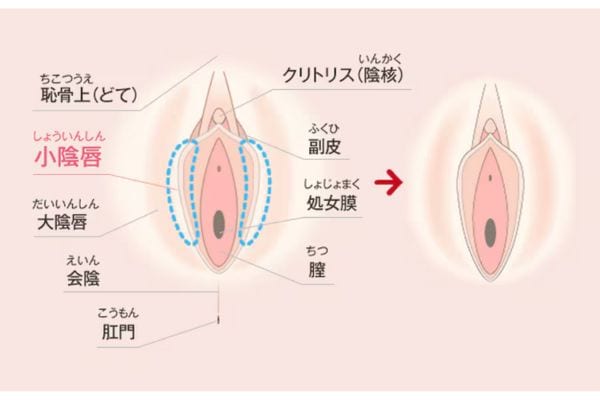 小陰唇縮小術 (抜糸あり・抜糸なし)<br />
