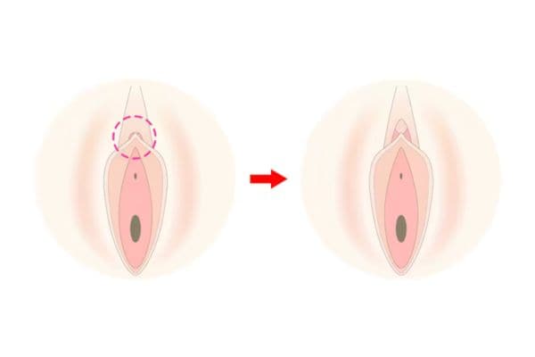 陰核包茎術(抜糸あり・抜糸なし)<br />
