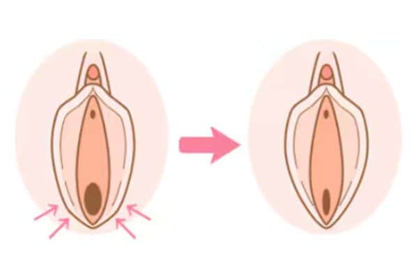 膣縮小術 (膣壁形成術)