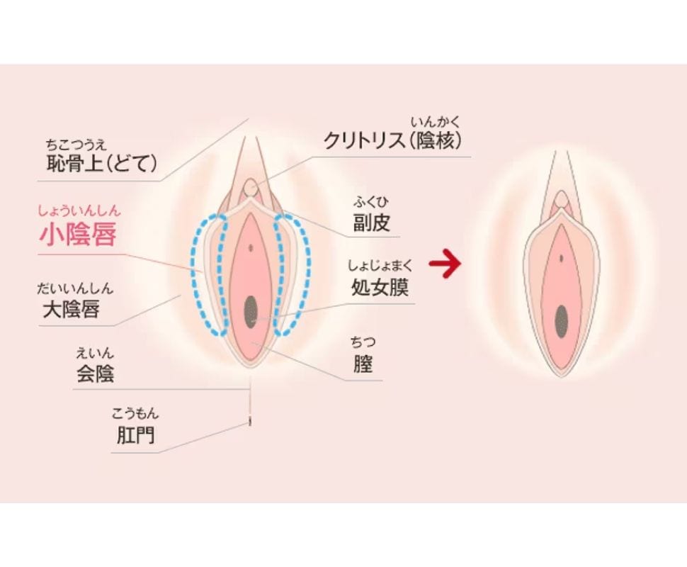 【小陰唇縮小術】小陰唇の黒ずみや左右差が気になる方へ