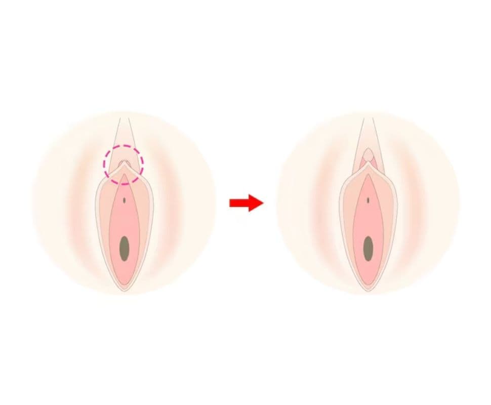 【陰核包茎術】不感症や性行為時の痛みにお悩みの方へ