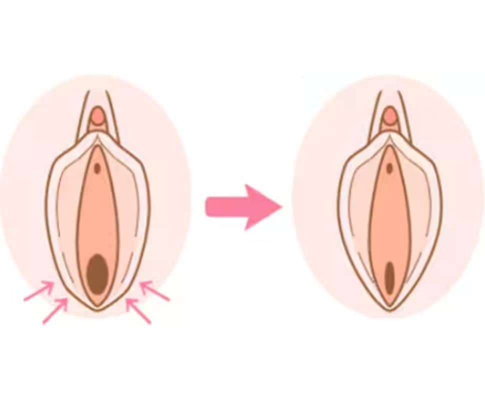 【膣壁形成術】膣の緩みが気になる方へ