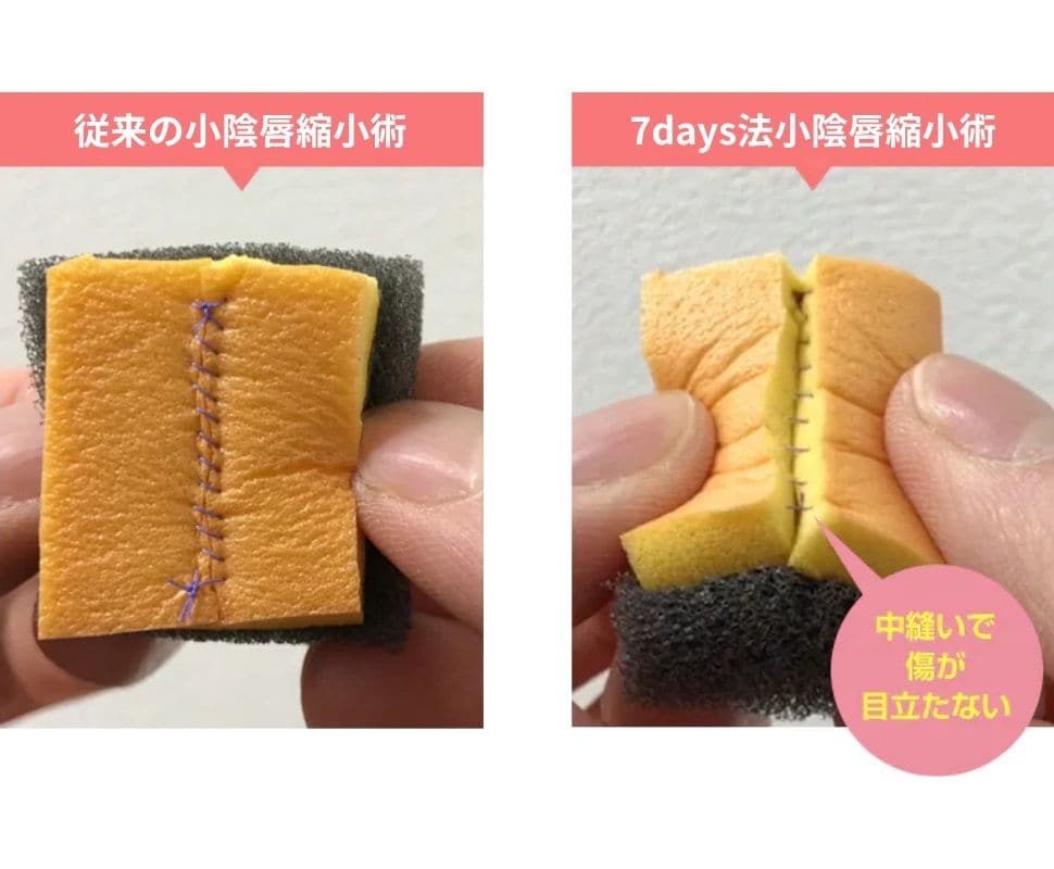 抜糸なし7days法