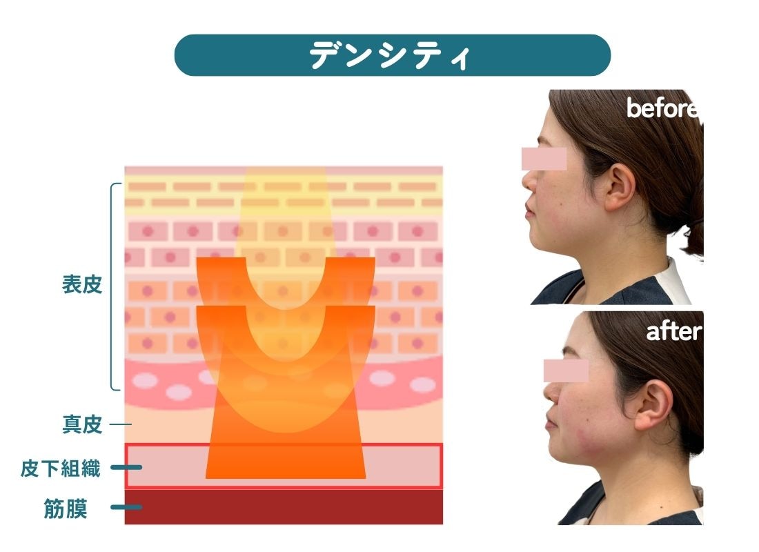 皮下組織にアプローチ！
