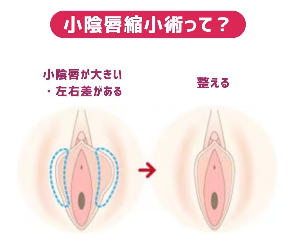 小陰唇縮小術って？