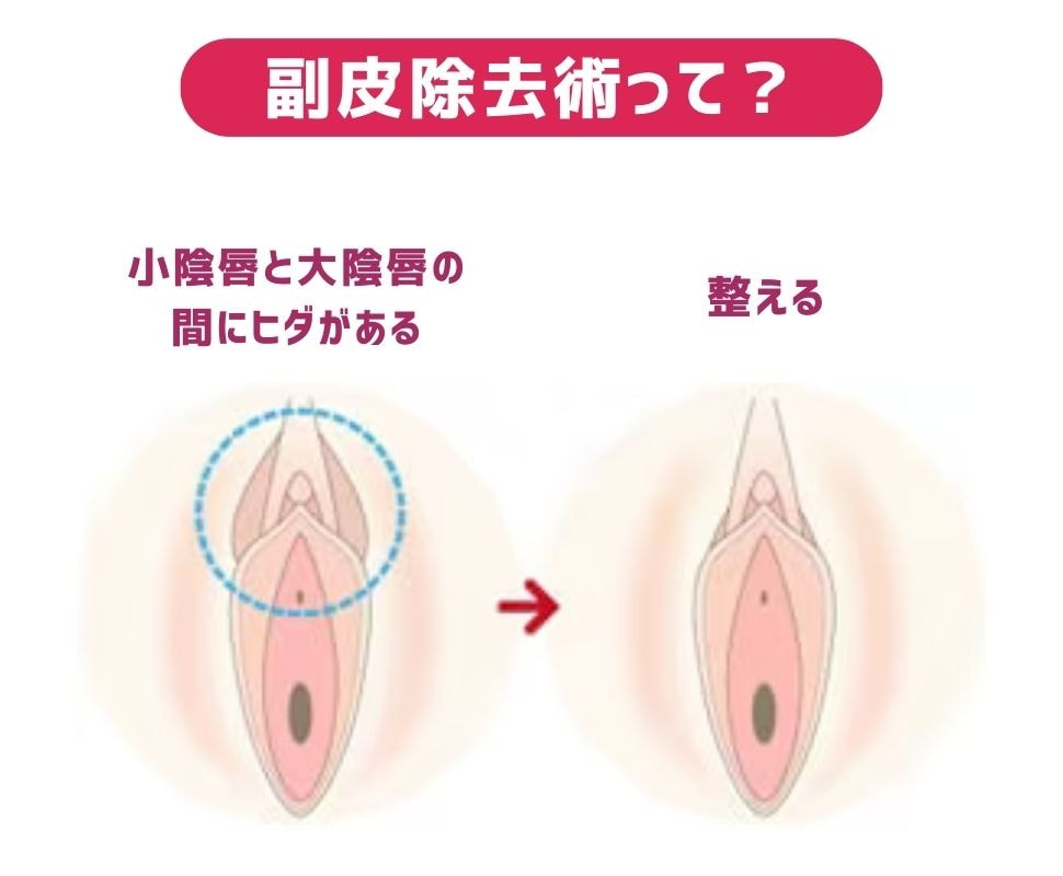 副皮除去術って？
