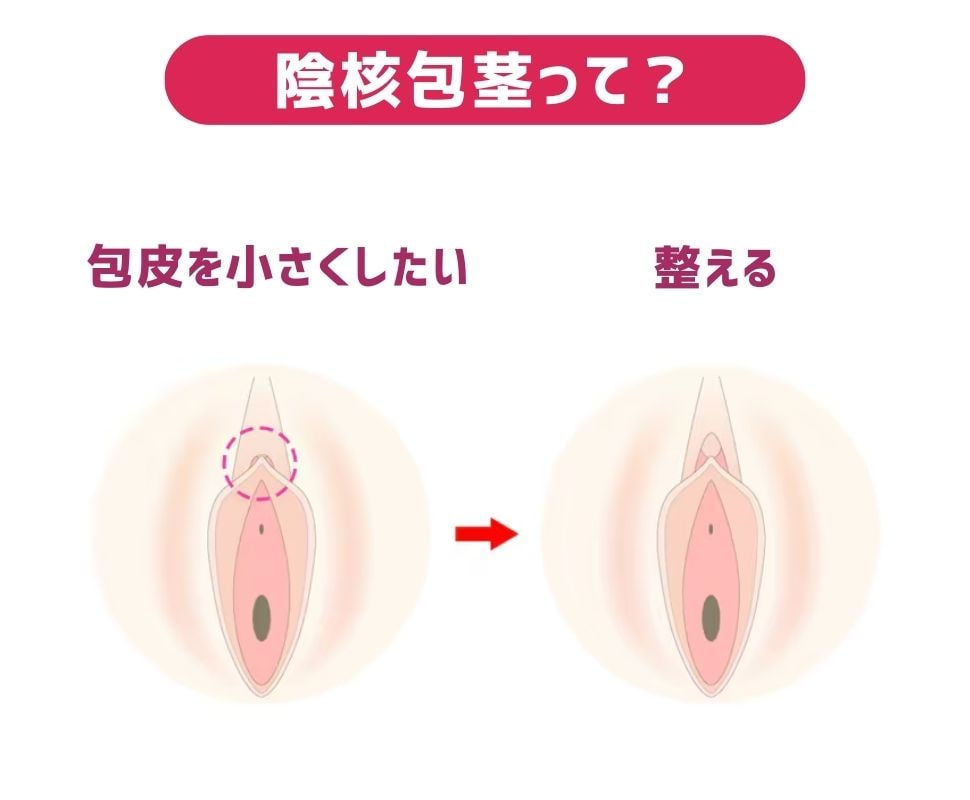 陰核包茎術って？<br />
