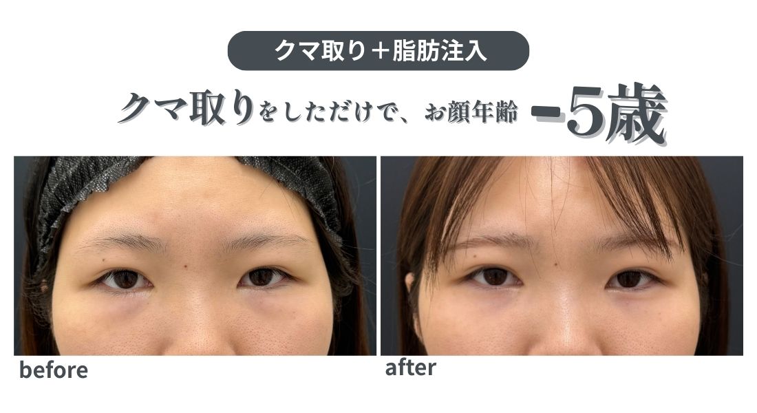 −5歳のクマ取り🐻✨