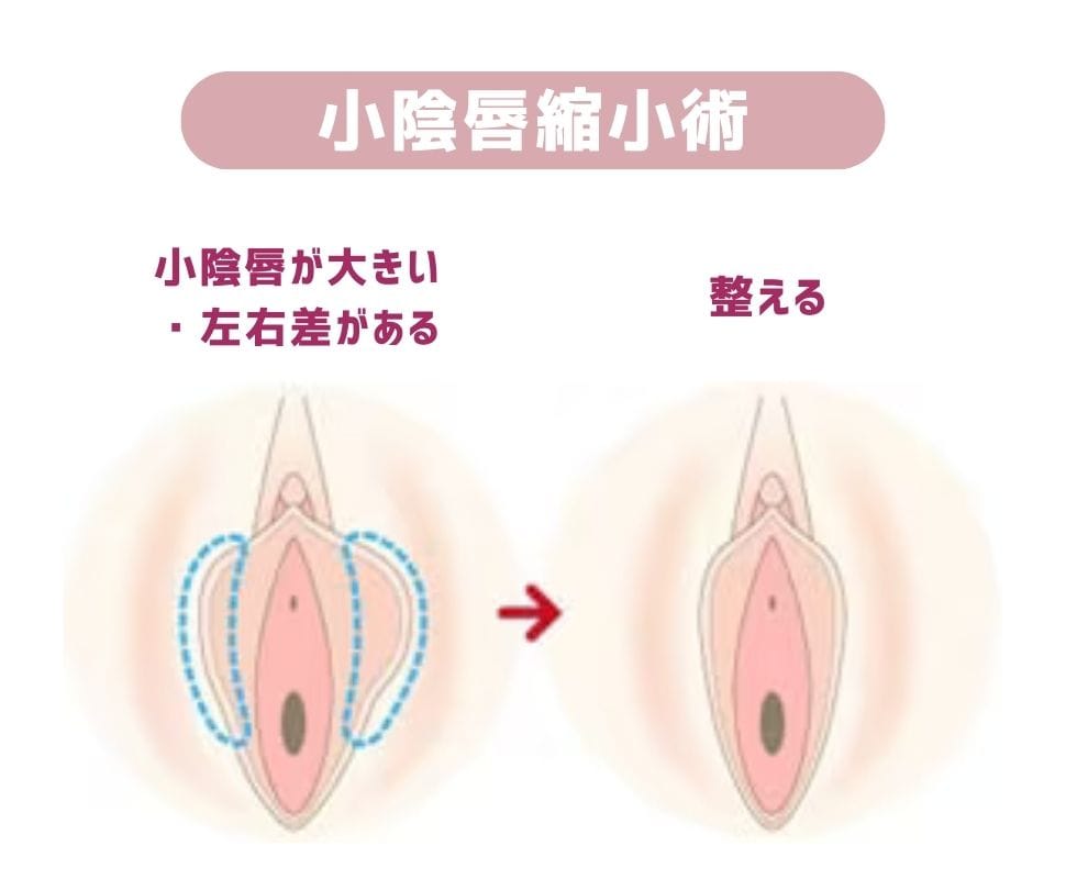 小陰唇縮小術