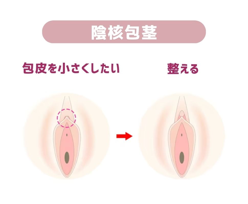 陰核包茎術