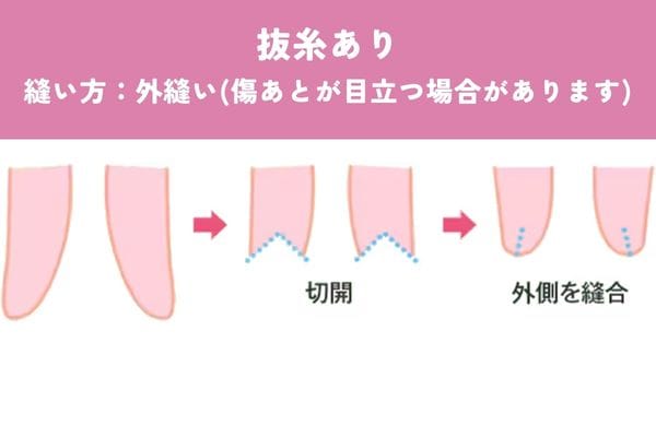 抜糸ありの場合