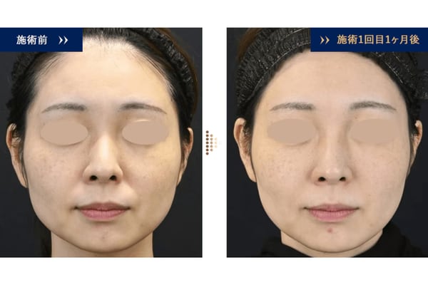 こめかみや頬のコケが改善！