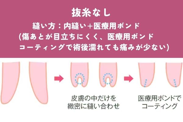抜糸なしの場合