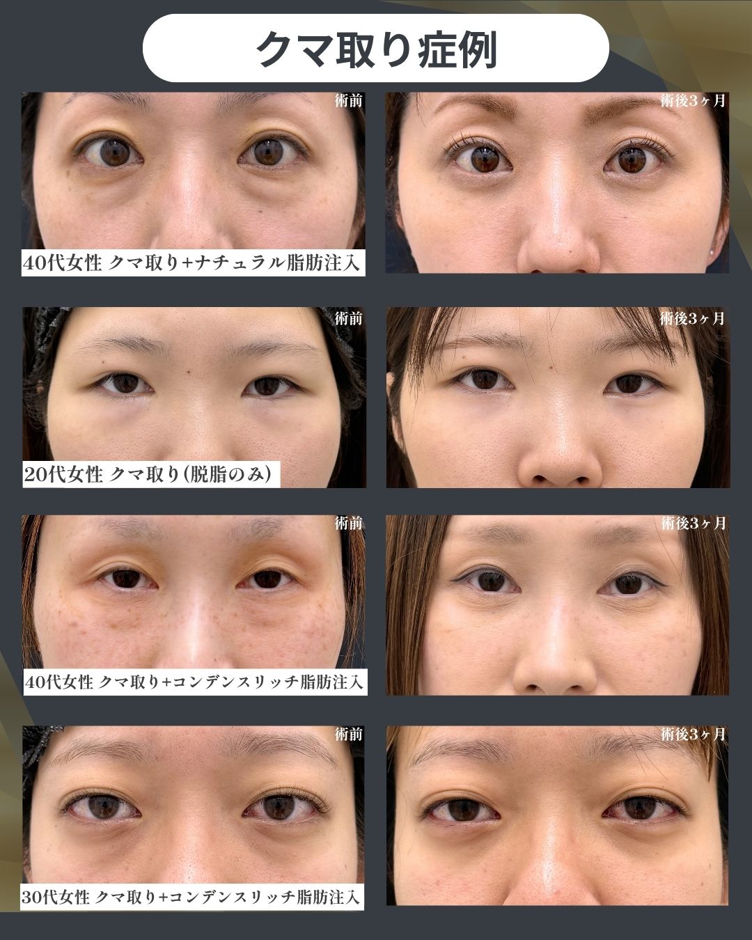 郡山院のクマ・たるみ改善症例公開
