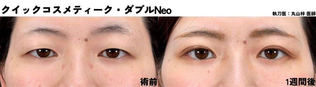 術後5日〜7日目】 腫れと内出血の引き始め