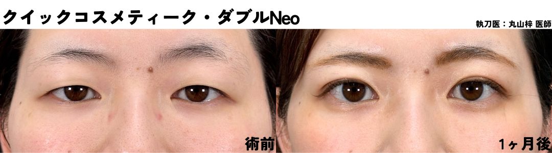h3：【術後1ヶ月後】 自然に仕上がり完成型に