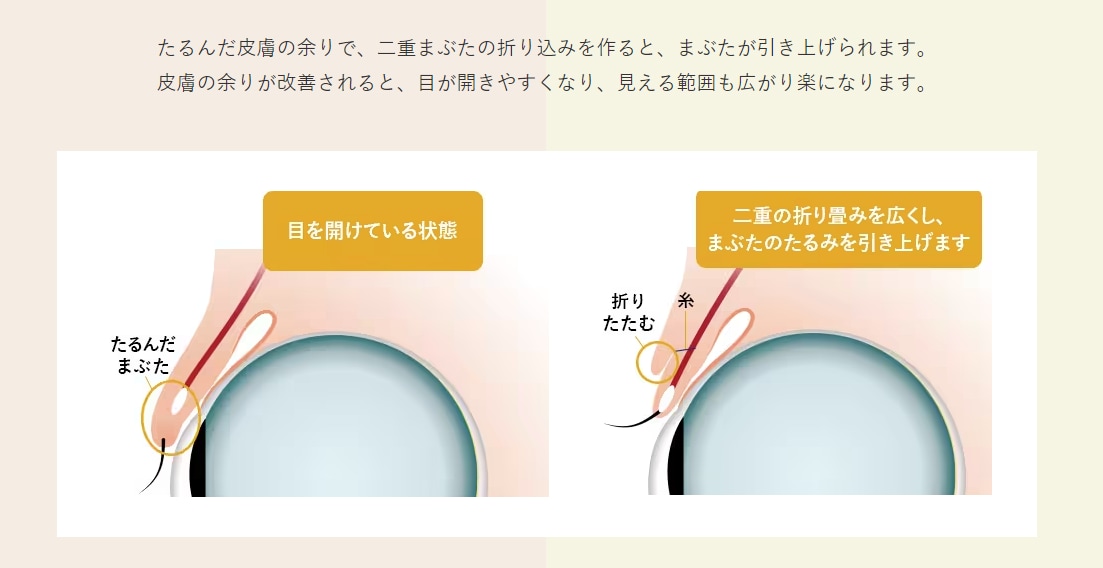 切らないまぶたのリフトアップって？