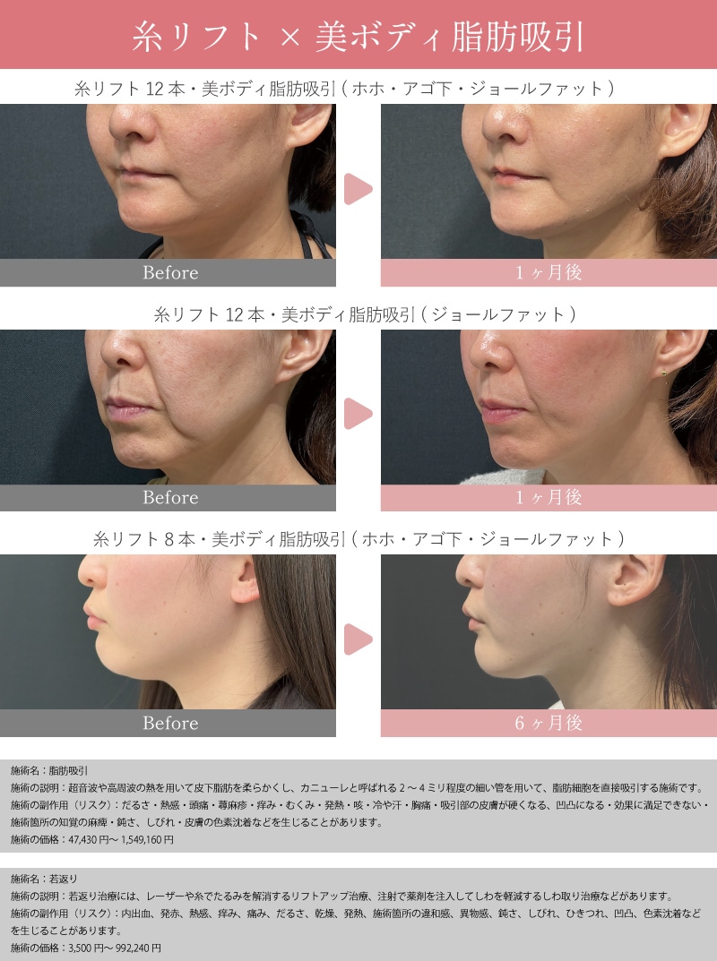 脂肪吸引との併用もおすすめです！