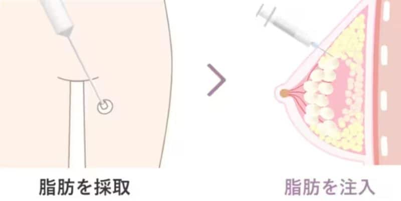 コンプレックスを自信に変える。部分痩せも叶う「自然な豊胸術」とは？