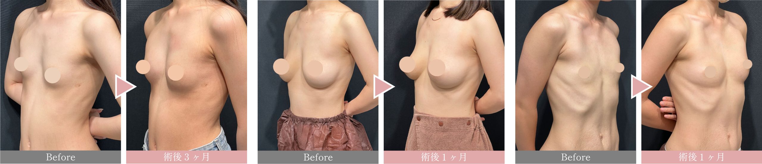 【渡部医師執刀】見た目・触り心地まで自然に！週末豊胸-ピュアグラフト-