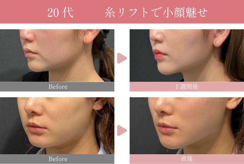 20代の糸リフト症例🤍